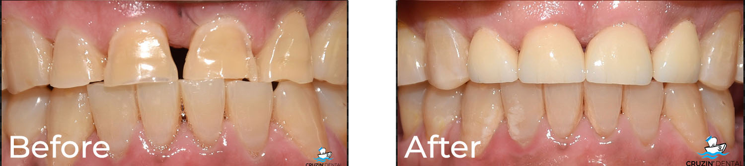 Cruzin  Dental | Sleep Apnea, Ceramic Crowns and Oral Exams