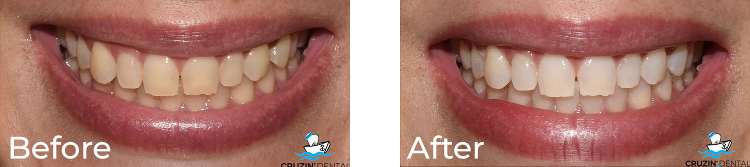 Cruzin  Dental | TMJ Disorders, Root Canals and Dentures