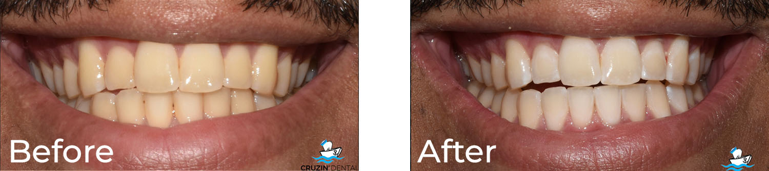 Cruzin  Dental | Cosmetic Dentistry, TMJ Disorders and Fluoride Treatment