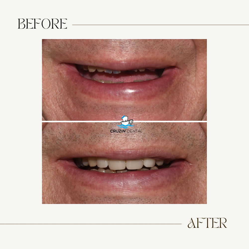Cruzin  Dental | Ceramic Crowns, Dental Bridges and Oral Cancer Screening