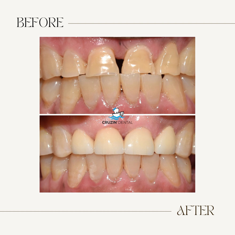 Cruzin  Dental | Dentures, Crowns and Veneers