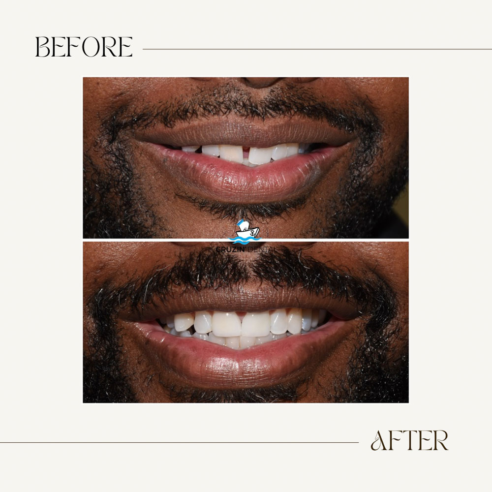 Cruzin' Dental | Digital Radiography, Juvederm&reg; and Snoring Appliances