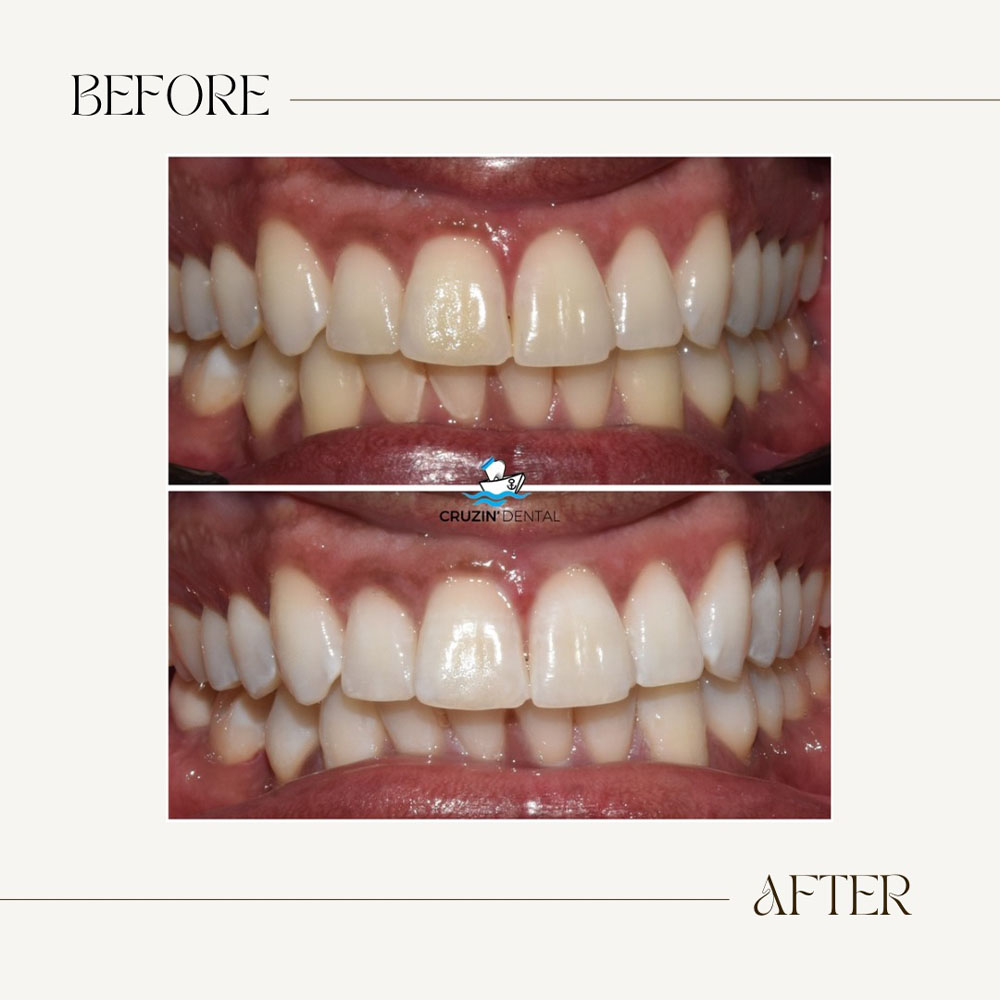 Cruzin  Dental | Veneers, Extractions and Sedation Dentistry