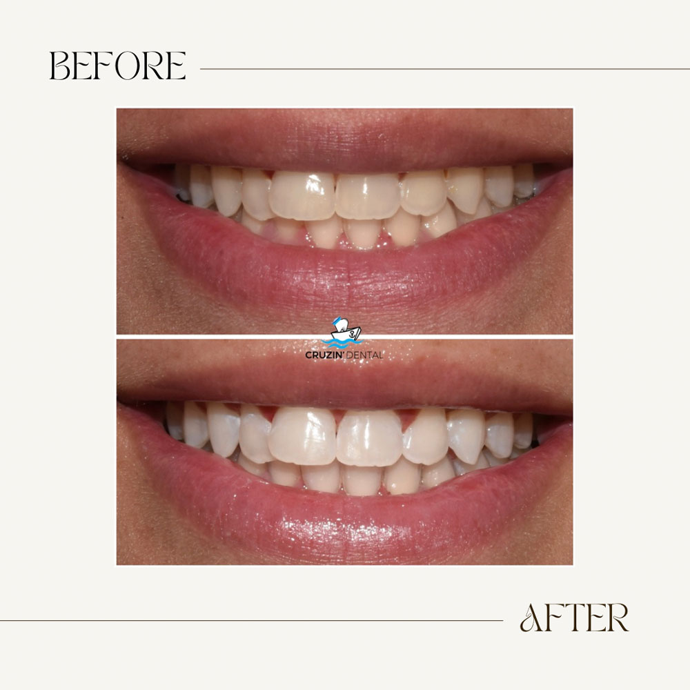 Cruzin  Dental | Botox reg , Cosmetic Dentistry and Inlays  amp  Onlays