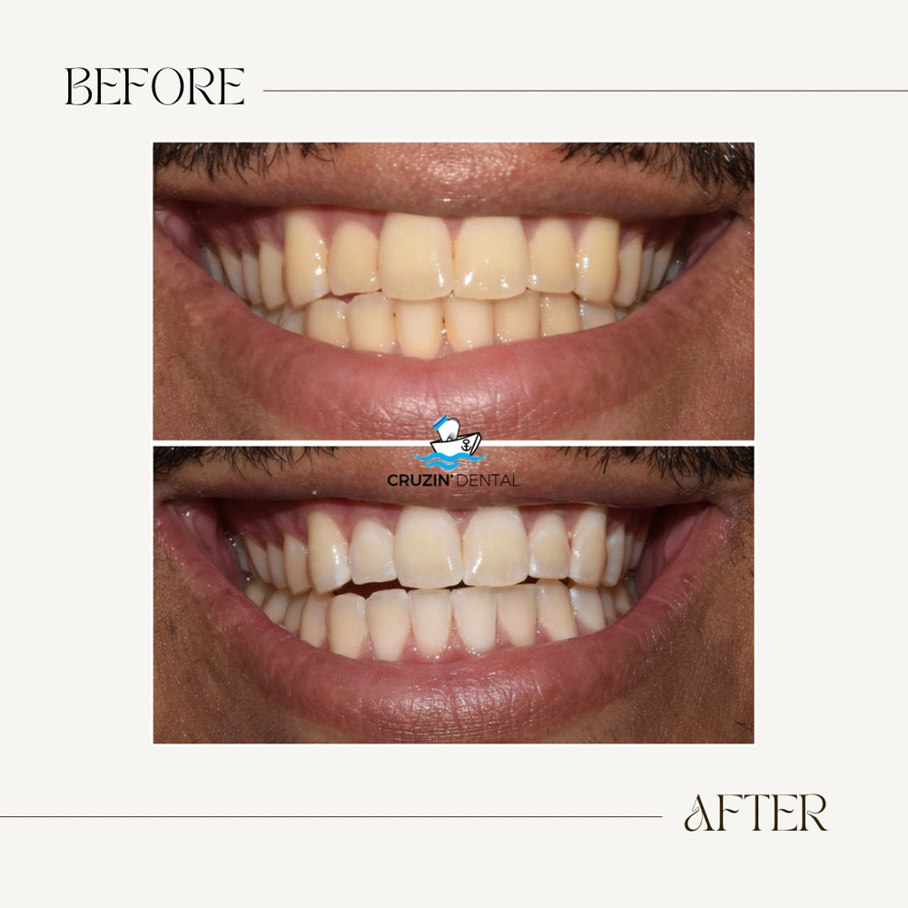 Cruzin  Dental | Fluoride Treatment, Pediatric Dentistry and Ceramic Crowns