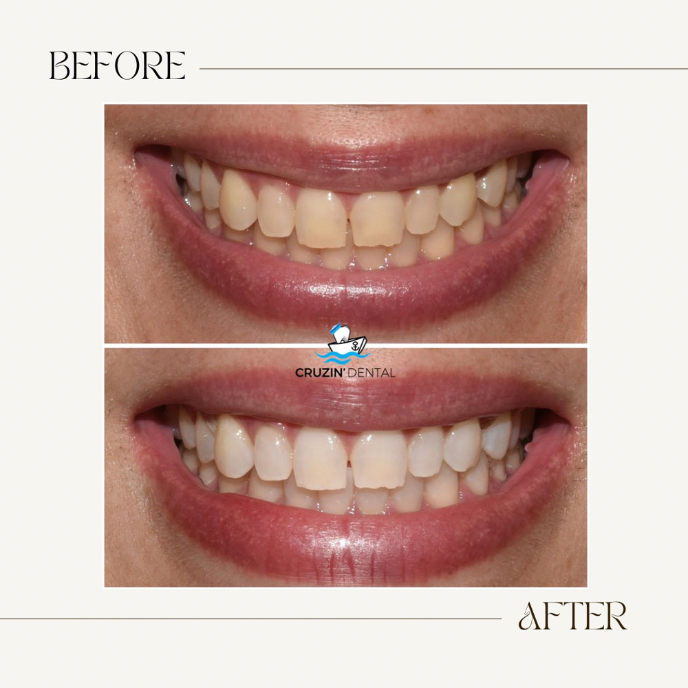 Cruzin  Dental | Pediatric Dentistry, Botox reg  and Periodontal Treatment