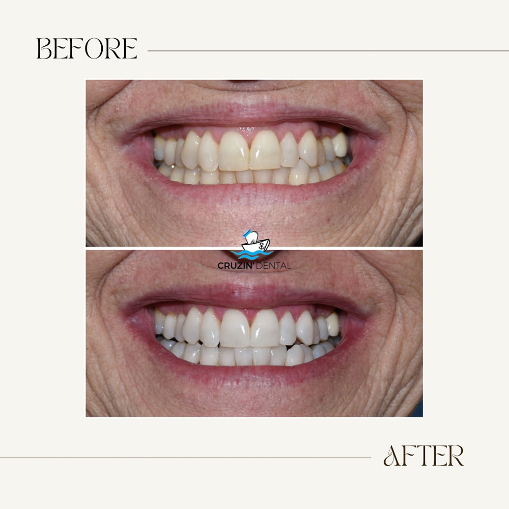 Cruzin  Dental | Sleep Apnea, Implant Dentistry and Preventative Program