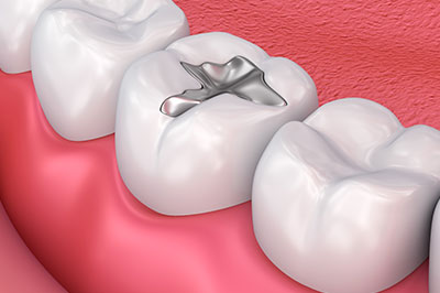 Cruzin  Dental | Periodontal Treatment, Root Canals and Digital Impressions