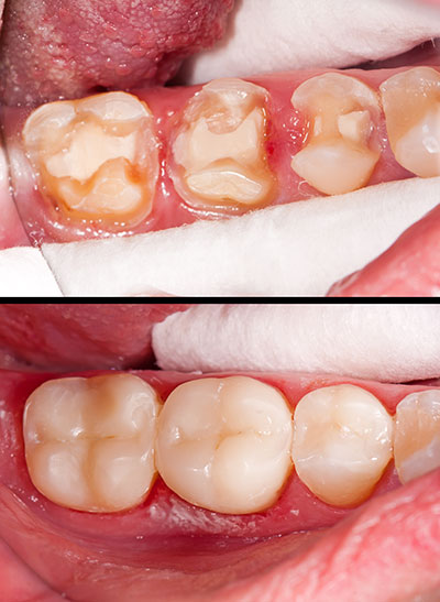 Cruzin  Dental | Oral Cancer Screening, Sedation Dentistry and ZOOM  Whitening