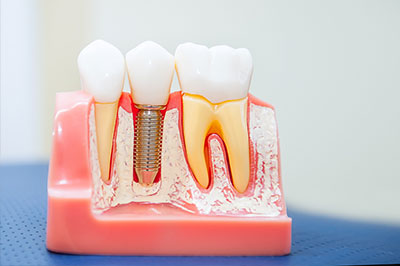Cruzin  Dental | Digital Impressions, Intraoral Camera and TMJ Disorders