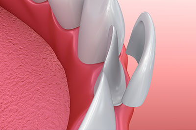 Cruzin  Dental | Intraoral Camera, Teeth Whitening and All-on-4 reg 