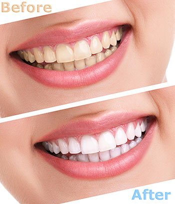 Cruzin  Dental | Cosmetic Dentistry, Night Guards and Snoring Appliances