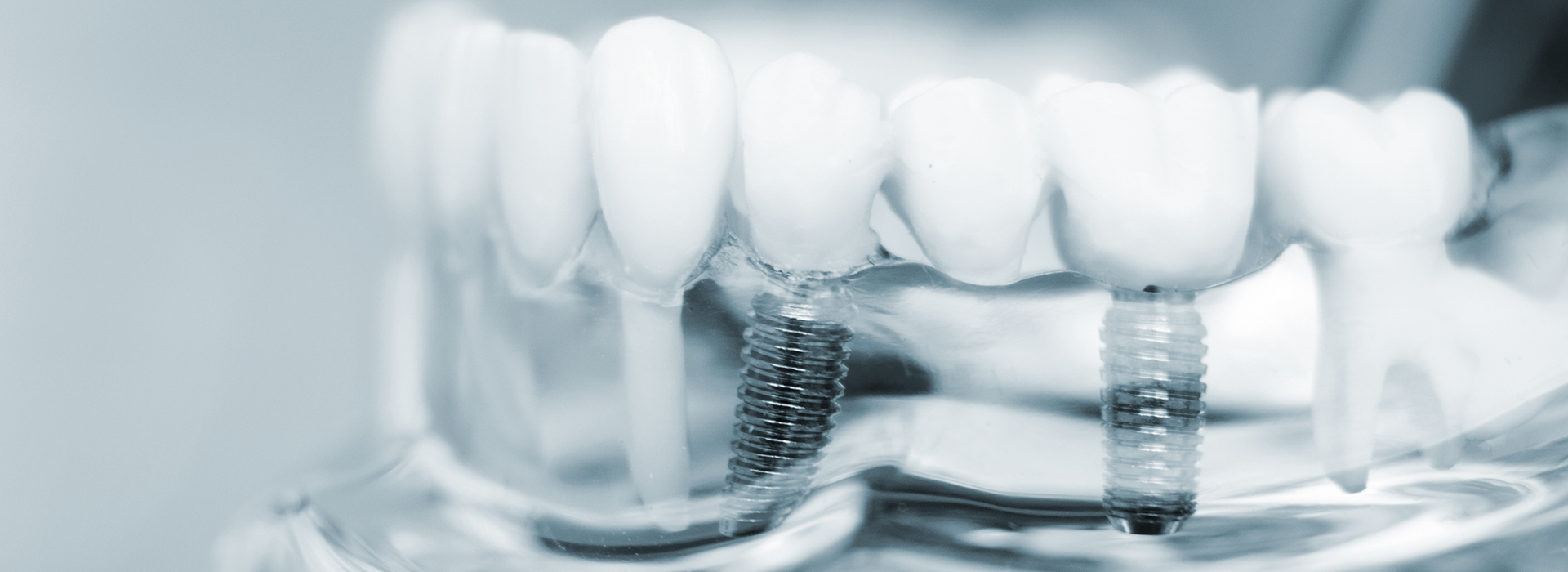 Cruzin  Dental | All-on-4 reg , TMJ Disorders and Veneers