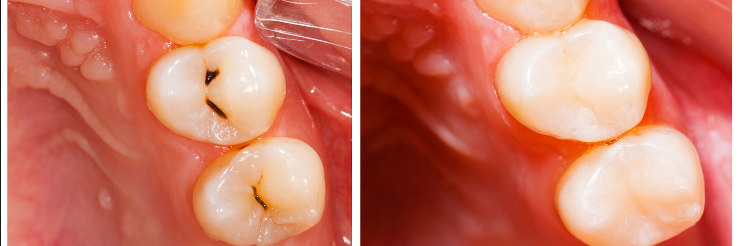 Cruzin  Dental | Dental Bridges, Sedation Dentistry and Cosmetic Dentistry