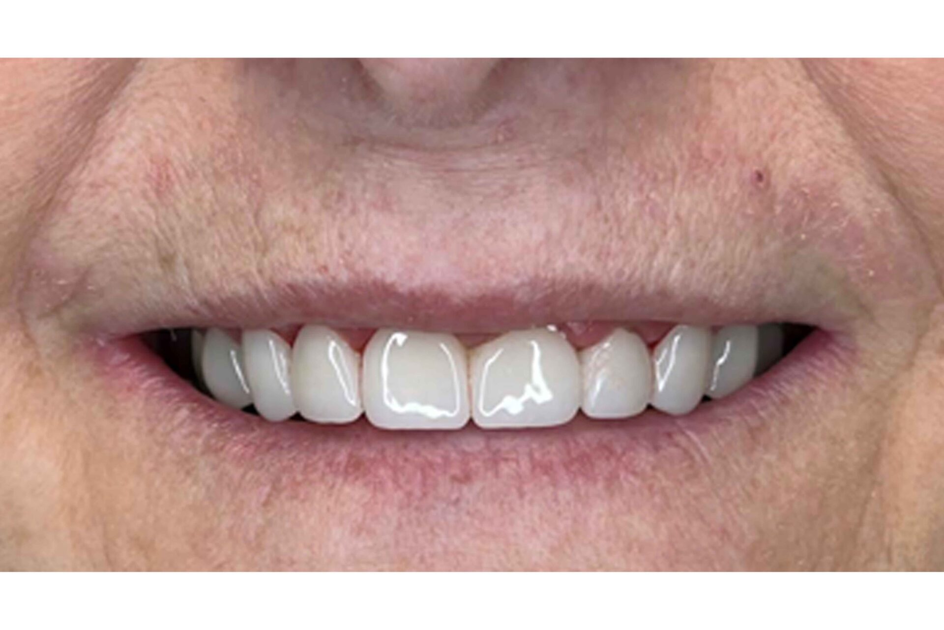 veneers in lehigh acres and port charlotte