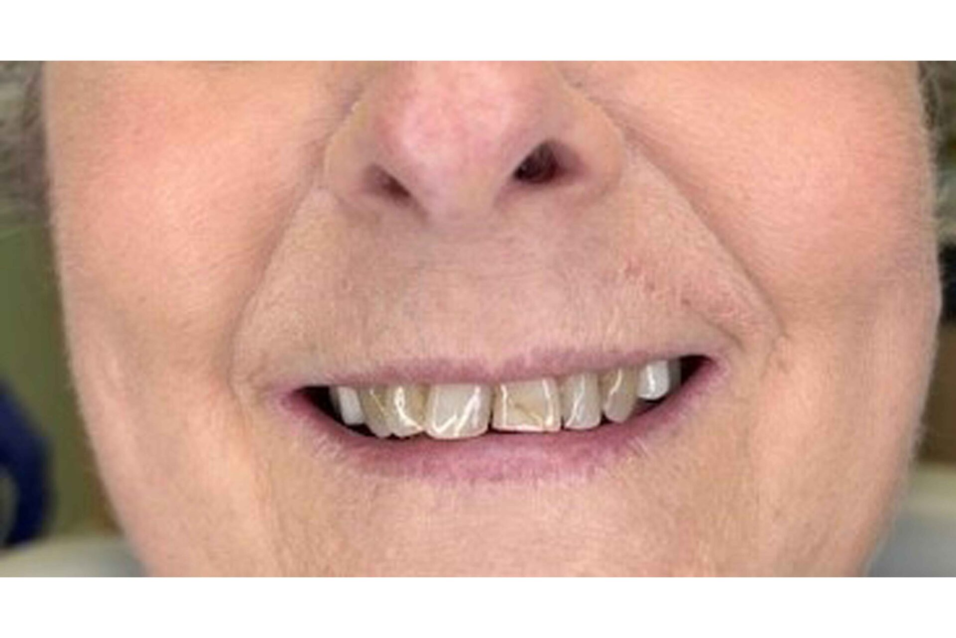 veneers in lehigh acres and port charlotte