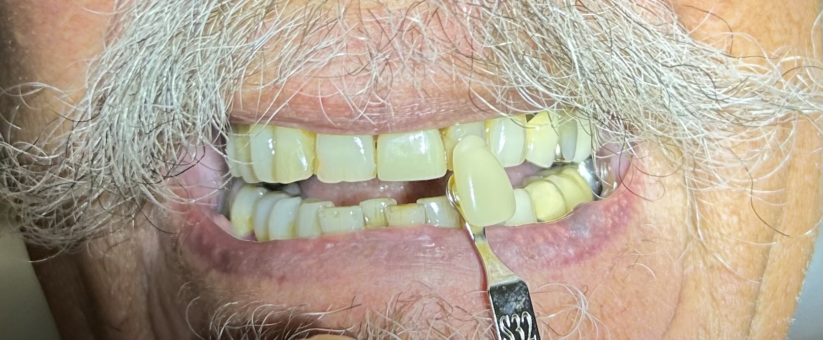 veneers in lehigh acres and port charlotte