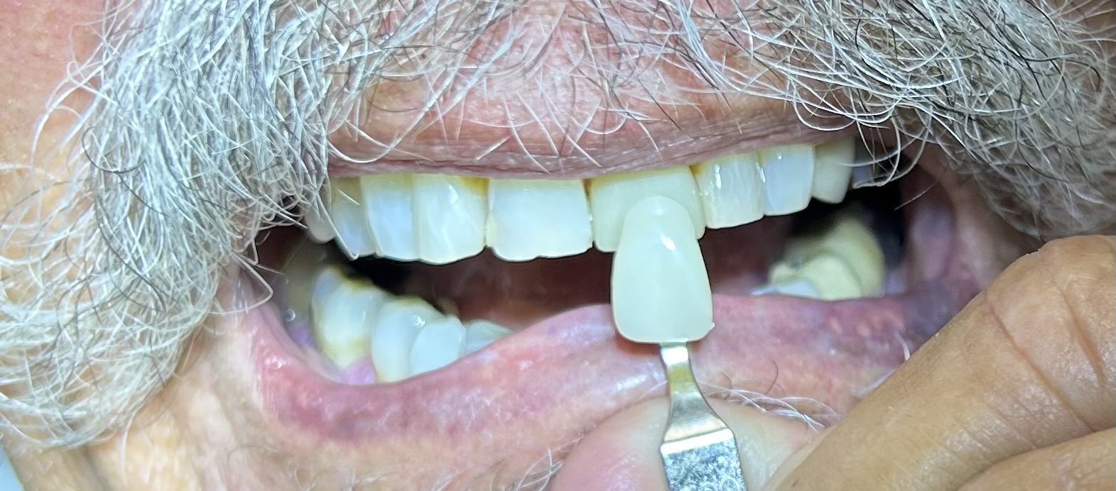 veneers in lehigh acres and port charlotte