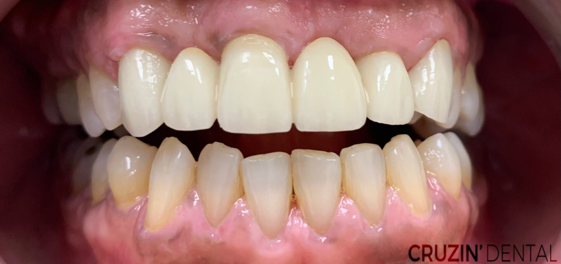 veneers in lehigh acres and port charlotte