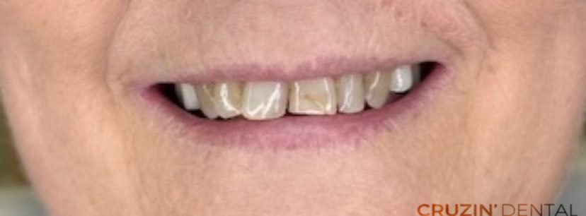 veneers in lehigh acres and port charlotte