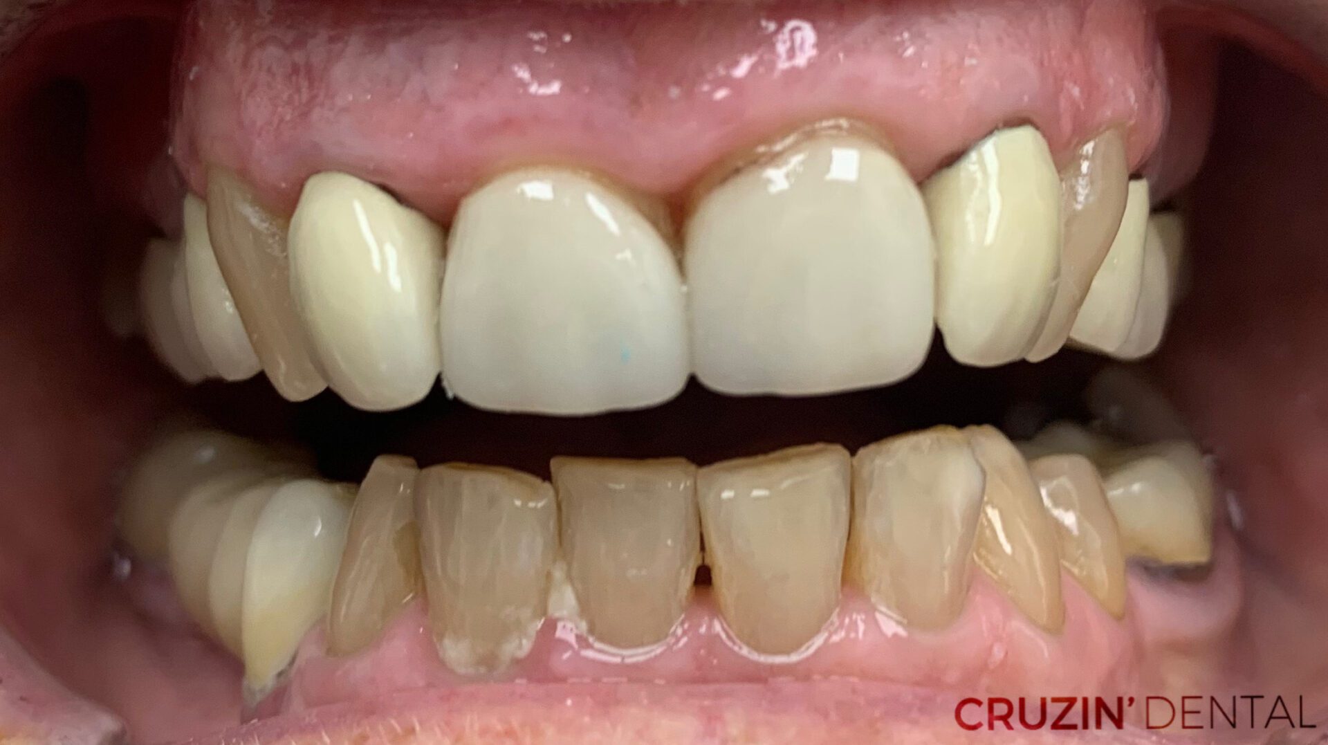 veneers in lehigh acres and port charlotte