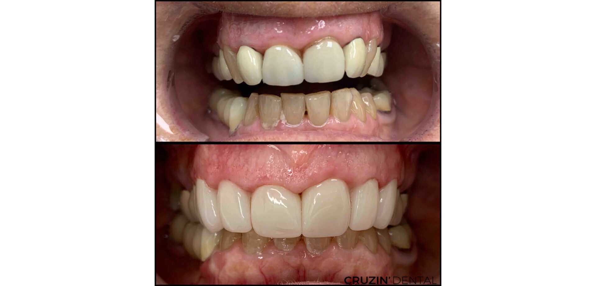 Donna 2 veneers in lehigh acres and port charlotte