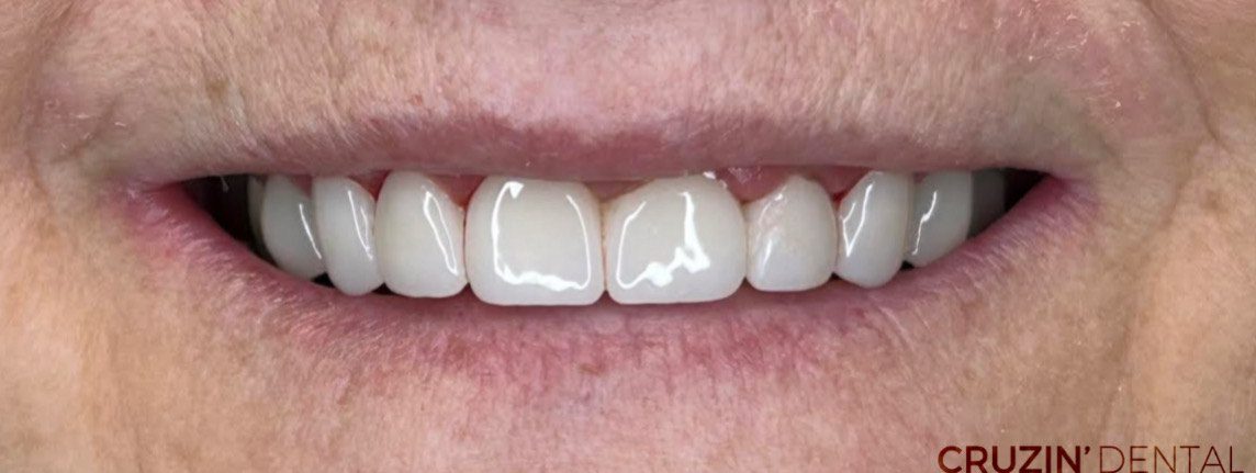 veneers in lehigh acres and port charlotte