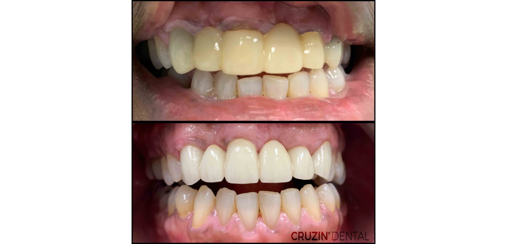 Rodolfus 2 veneers in lehigh acres and port charlotte