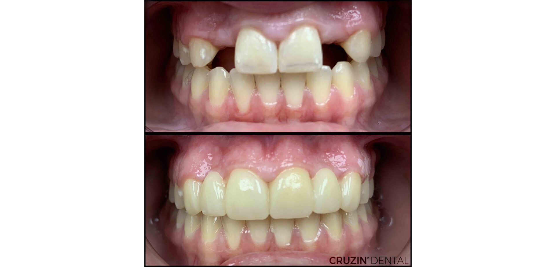 alissa2 veneers in lehigh acres and port charlotte