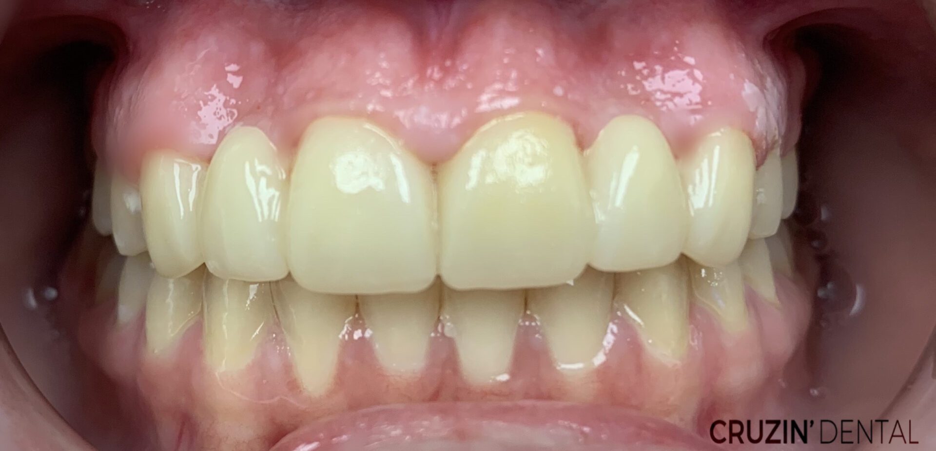 veneers in lehigh acres and port charlotte