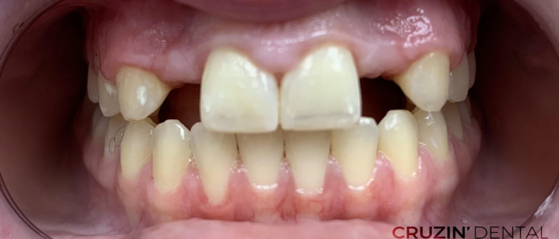 veneers in lehigh acres and port charlotte