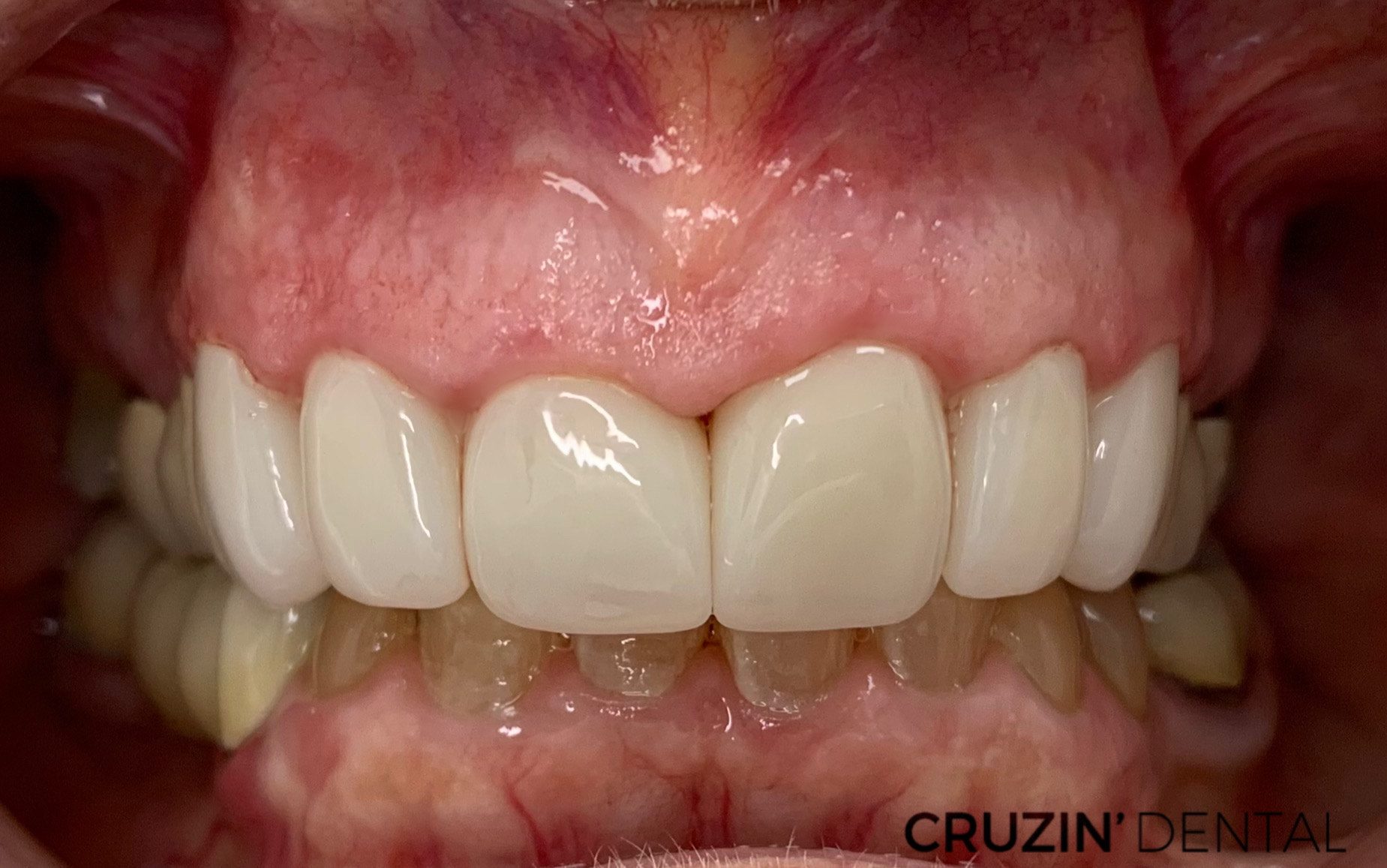 veneers in lehigh acres and port charlotte