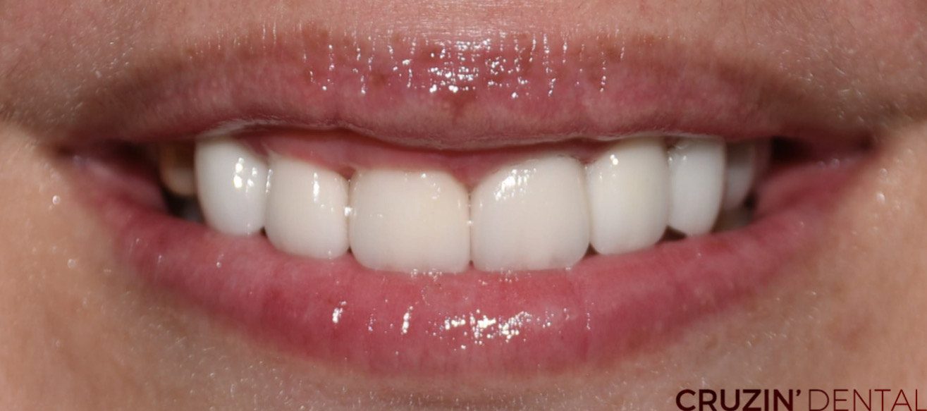 48AD70D0-AC35-4138-8471-6ECDABC474D2 veneers in lehigh acres and port charlotte