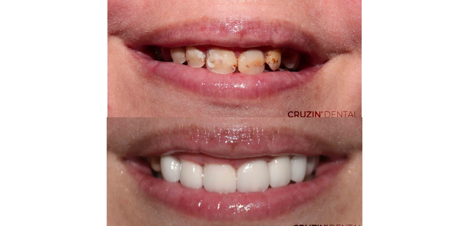crowns veneers in lehigh acres and port charlotte