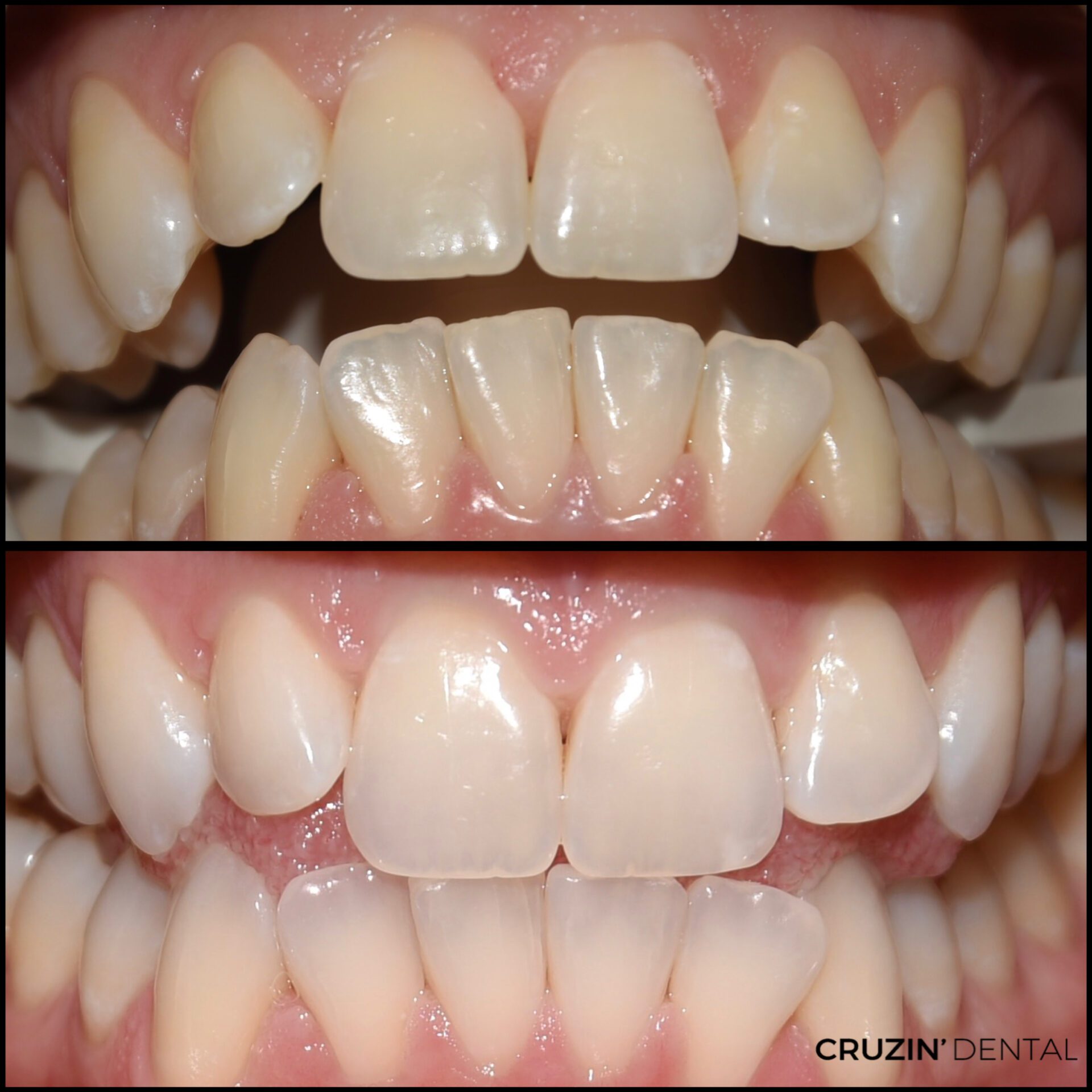 2025-05-07 11.22.56 veneers in lehigh acres and port charlotte