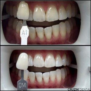 2025-05-07 11.23.37 veneers in lehigh acres and port charlotte