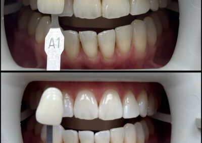 Zoom Whitening