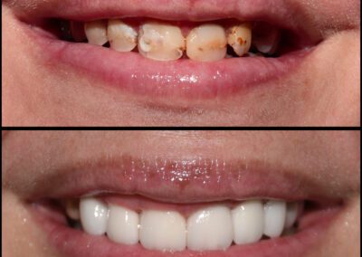 Cosmetic Crowns