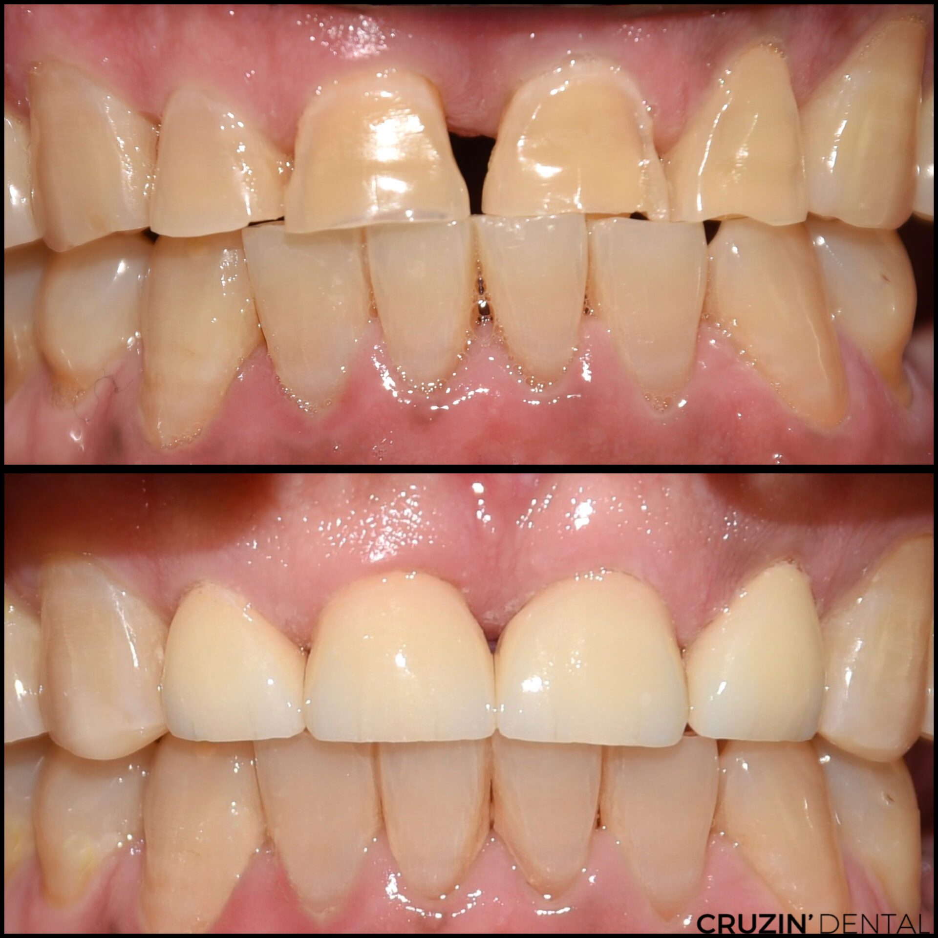 8B623413-713F-4CBB-8B44-46B208B04CEF veneers in lehigh acres and port charlotte